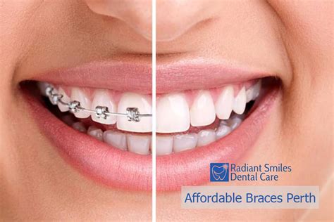 cheap braces in my area